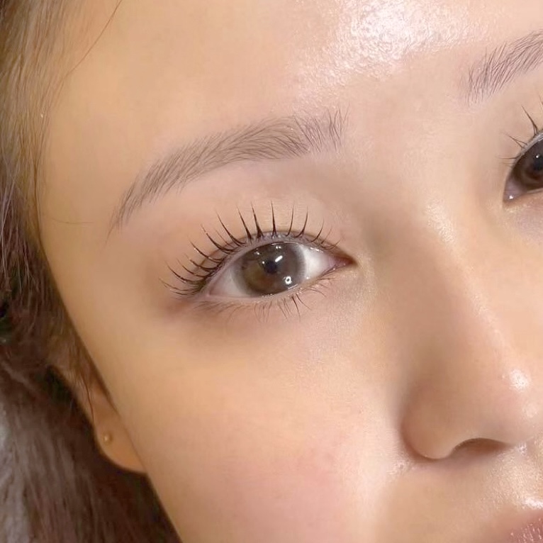 施術後の目元の画像